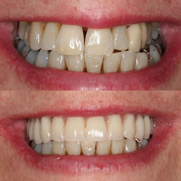 Eileen Full Arch Implants