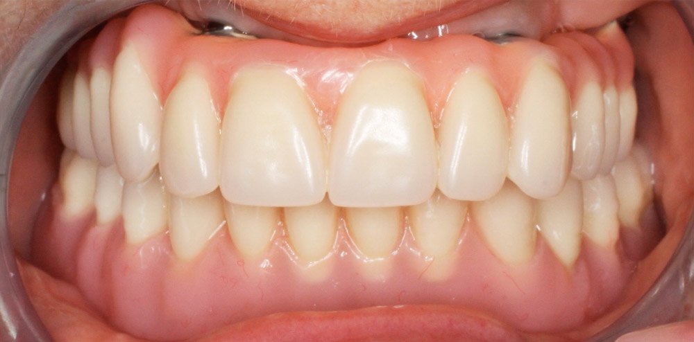 gabby_implant_retained_denture_1000_70.jpg