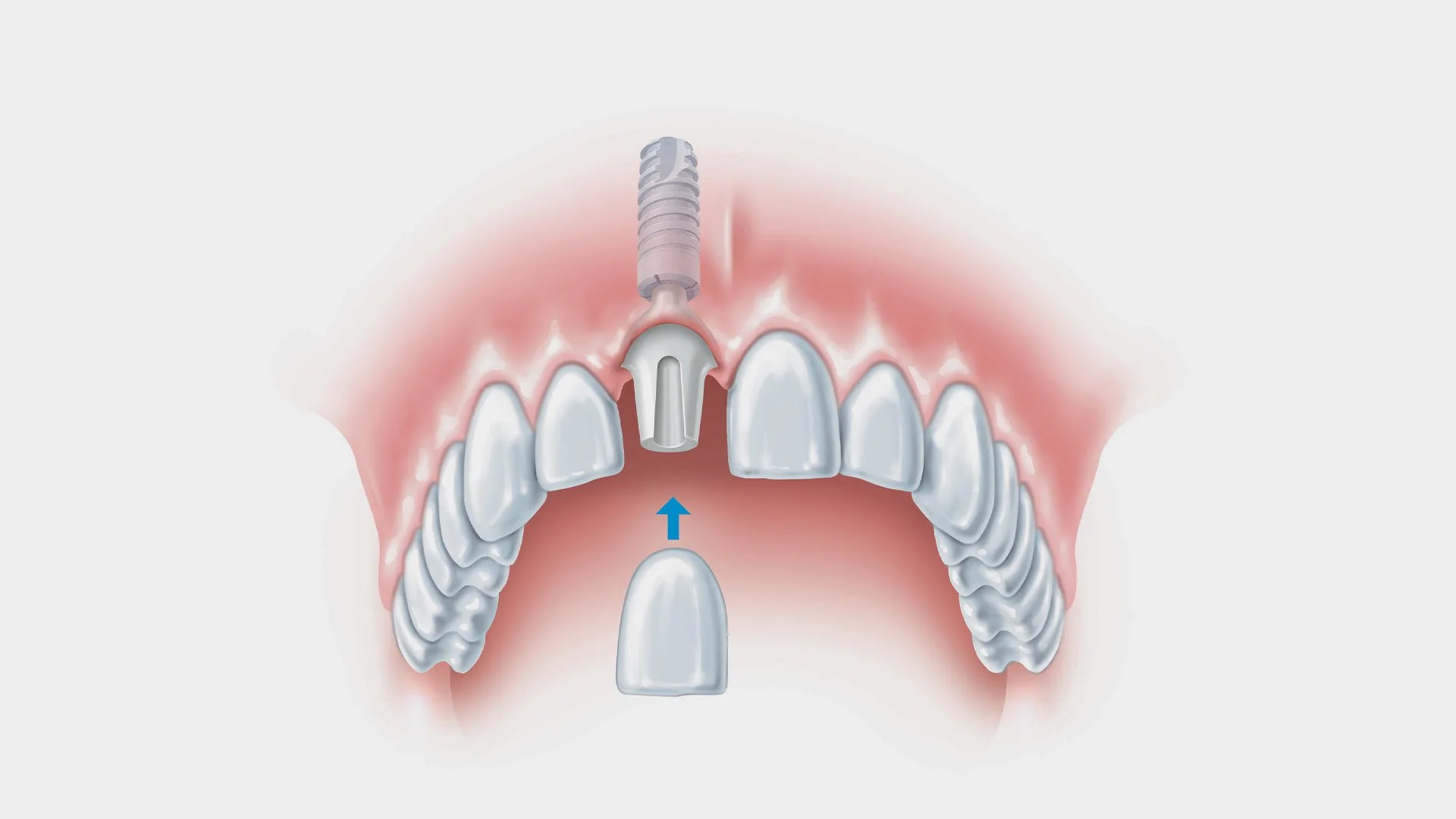 Single Implant Treatment