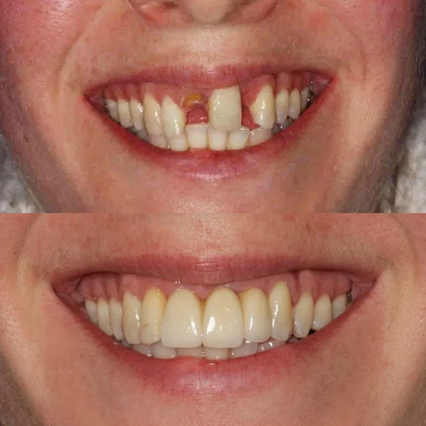 Charlotte Single Tooth Implants