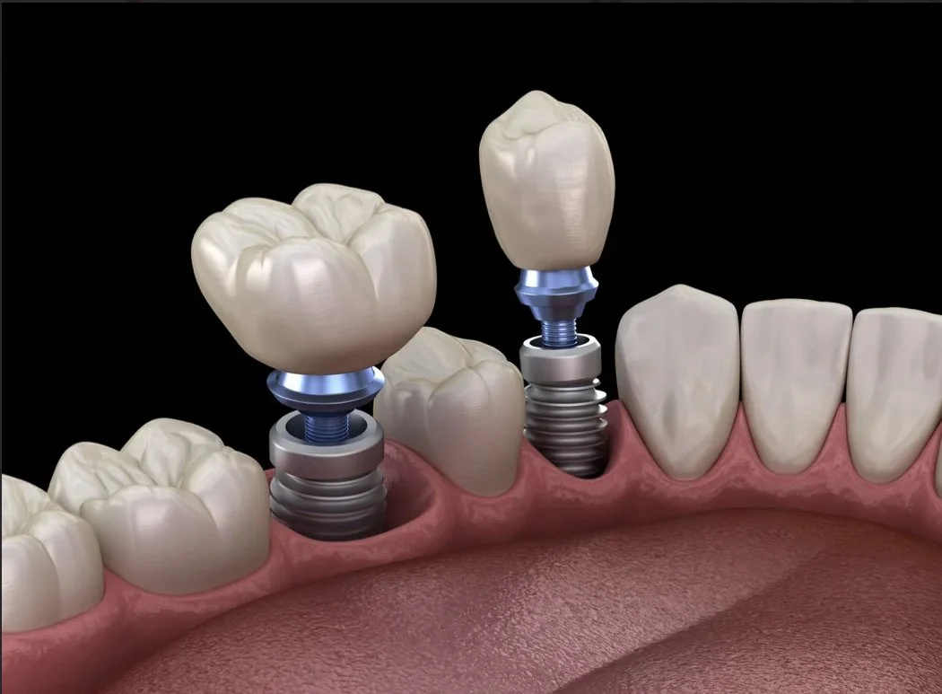 Restorative Dentistry — Whitman Family Dental Colfax, WA Dentist