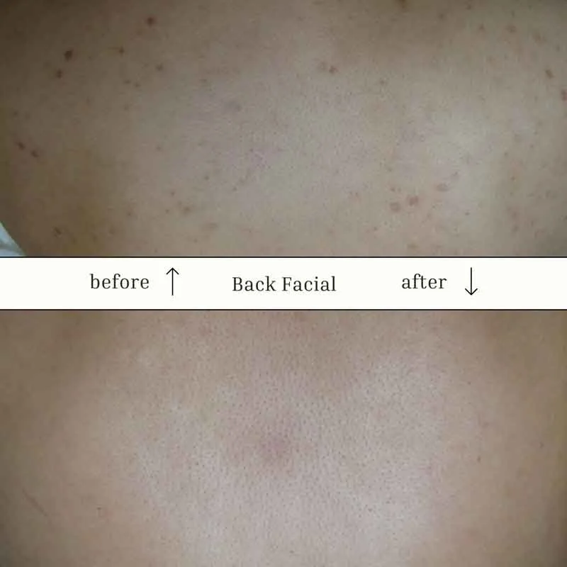Face Reality Back Facial.jpg