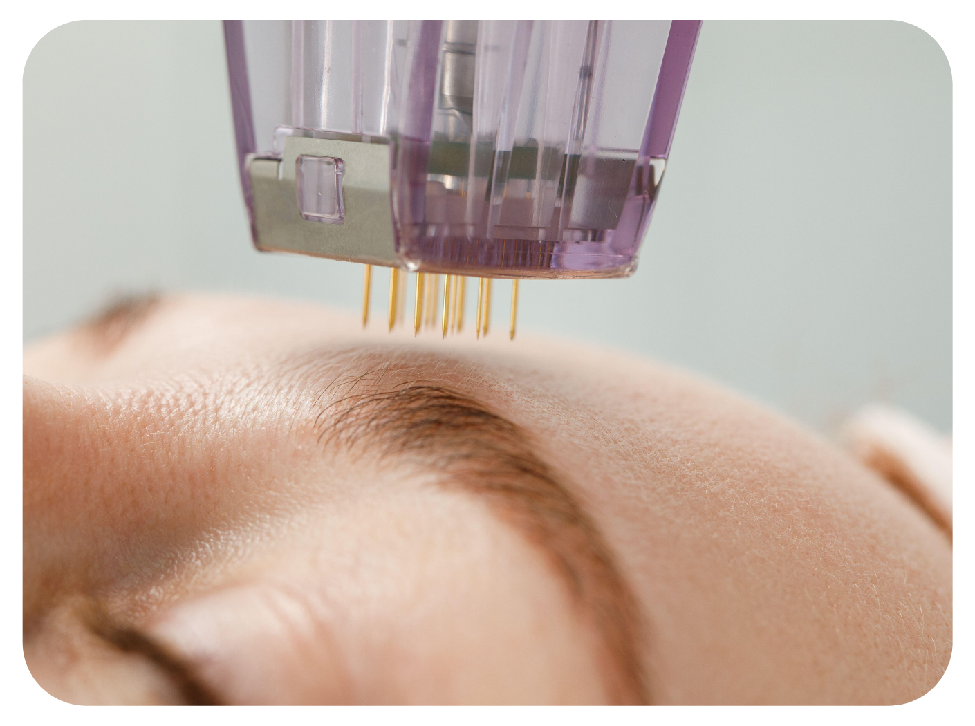 Microneedling to  Boost Collagen Production