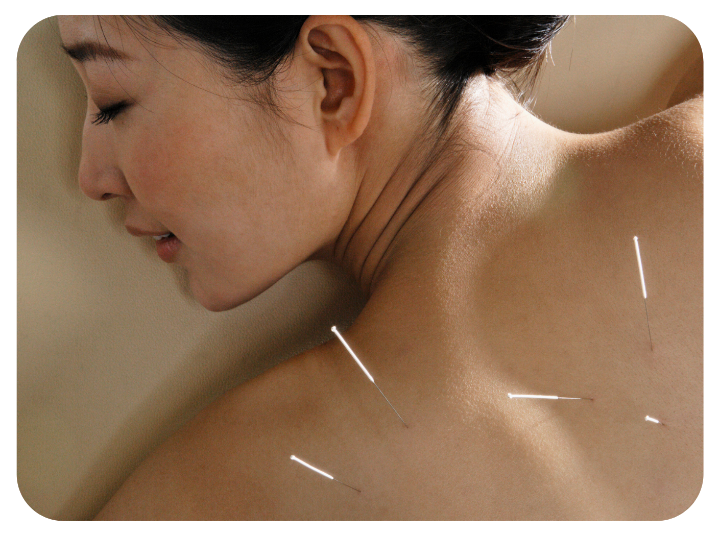 Restore Energy Flow with Acupuncture