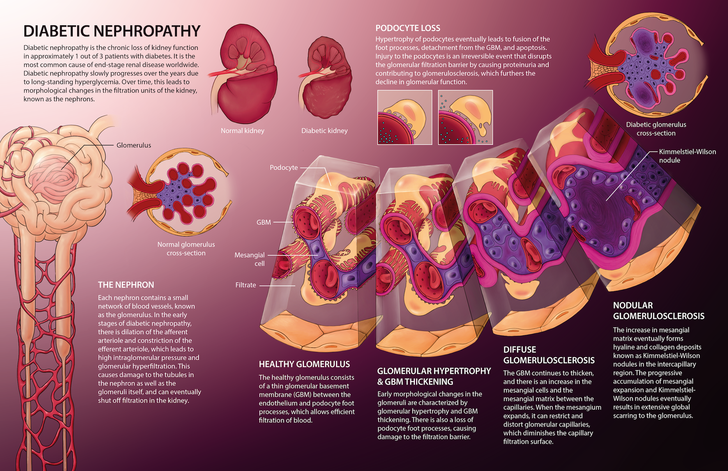 Pathology of Diabetic Nephropathy