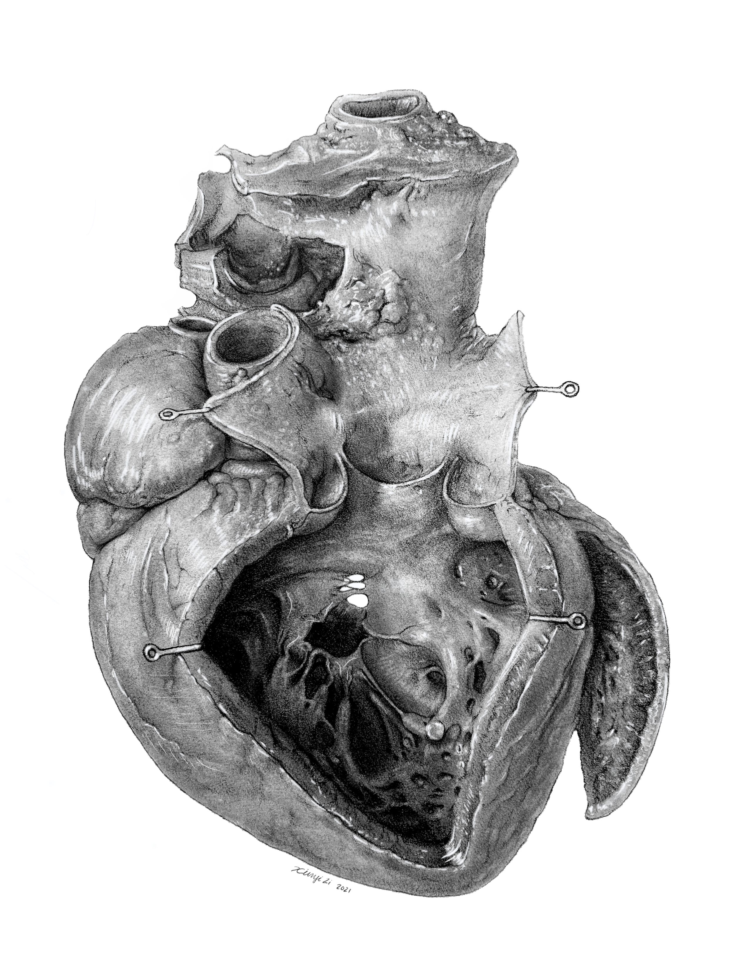 Brödel Heart Study