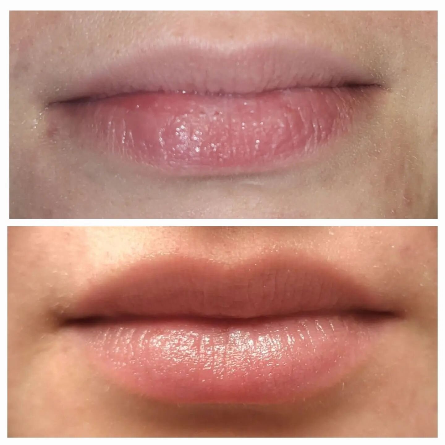 Another amazing Lip Fillers done by Beauty Booster Ferndale. Ste 2.