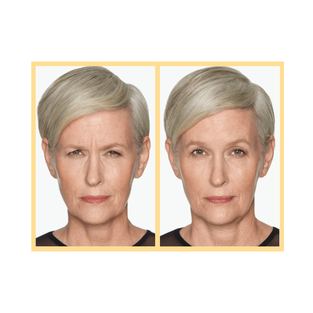 Daxxify® Injections in Aurora, IL and Downtown Batavia, IL