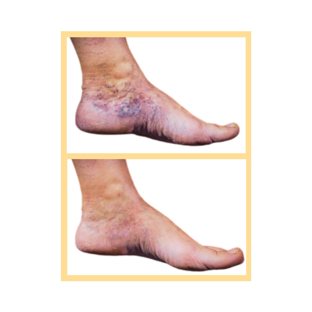 Spider Vein and Varicose Vein Treatment in Aurora, IL and Downtown Batavia, IL