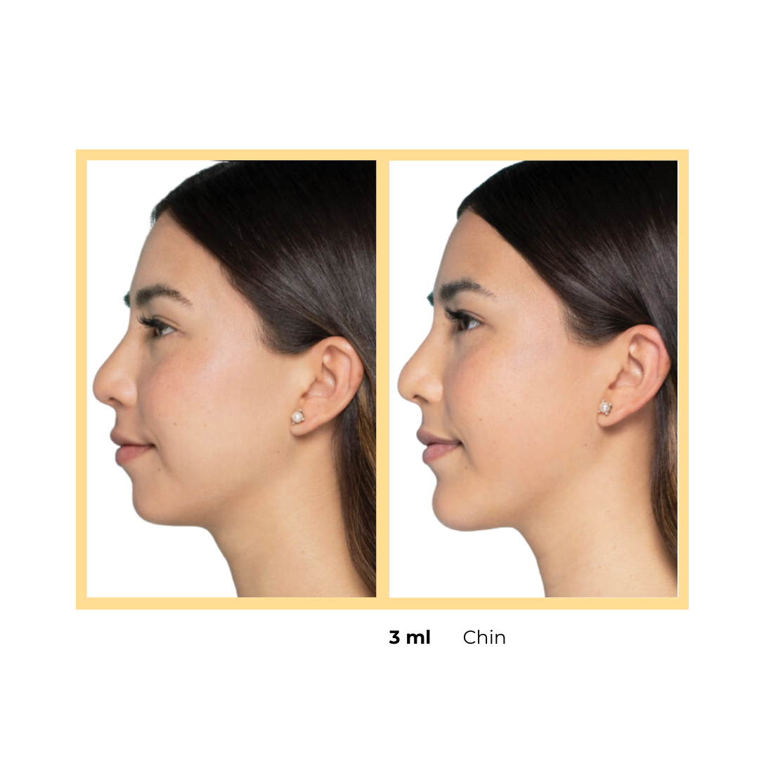 Restylane®  Chin Injections in Aurora, IL and Downtown Batavia, IL