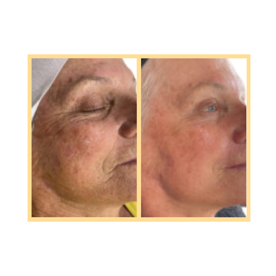 OxyGeneo™ 3-in-1 Super Facial in Aurora, IL and Downtown Batavia, IL