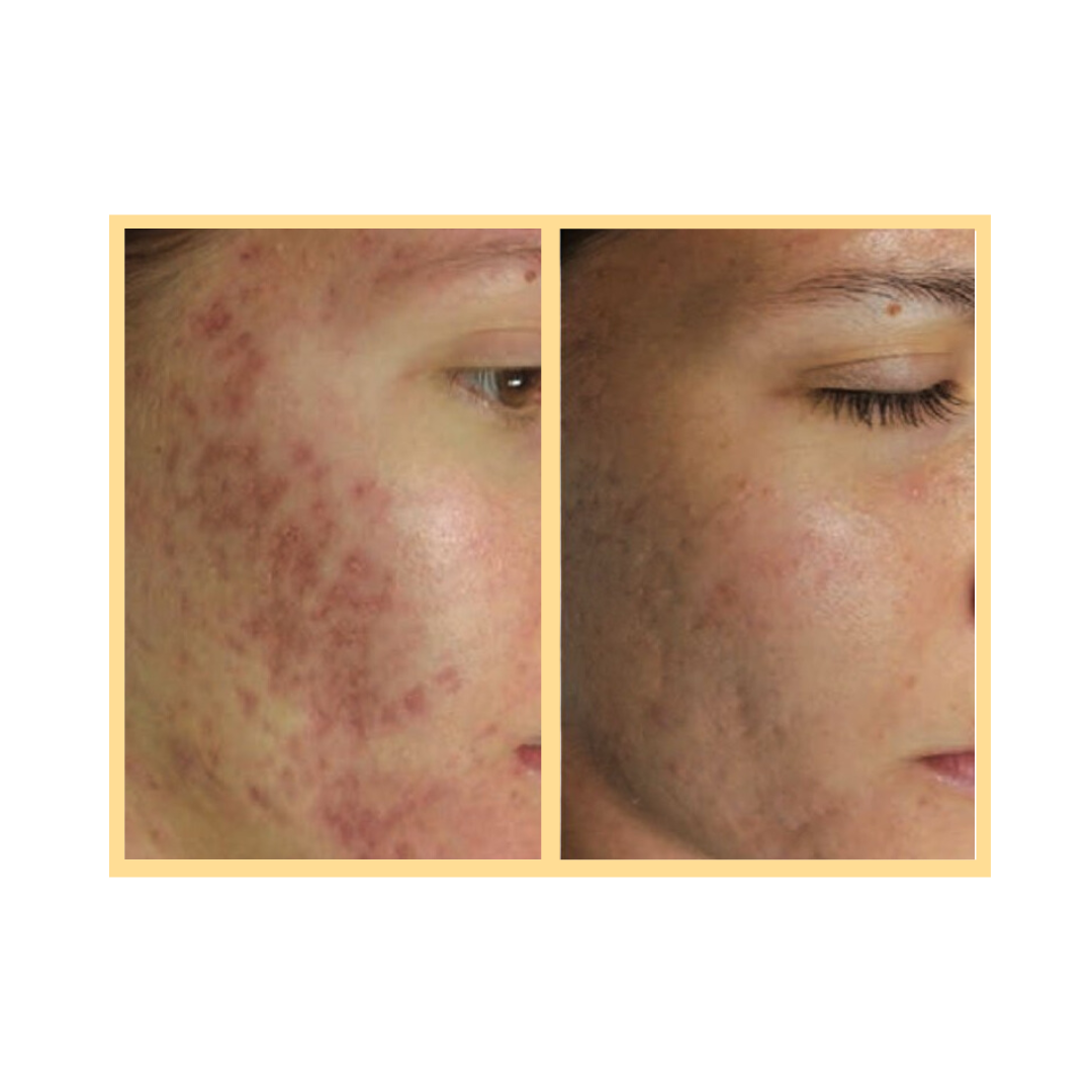 Exceed Microneedling Acne Treatment in Auora, IL and Downtown Batavia, IL