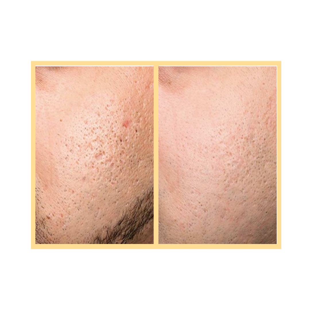 Exceed Microneedling Scarring Treatment in Auora, IL and Downtown Batavia, IL