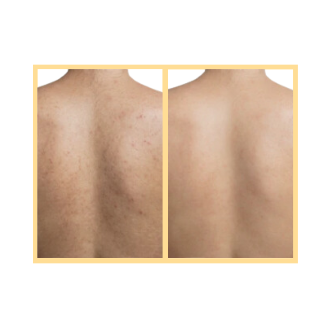 OxyGeneo Back Facial in Aurora, IL and Downtown Batavia, IL