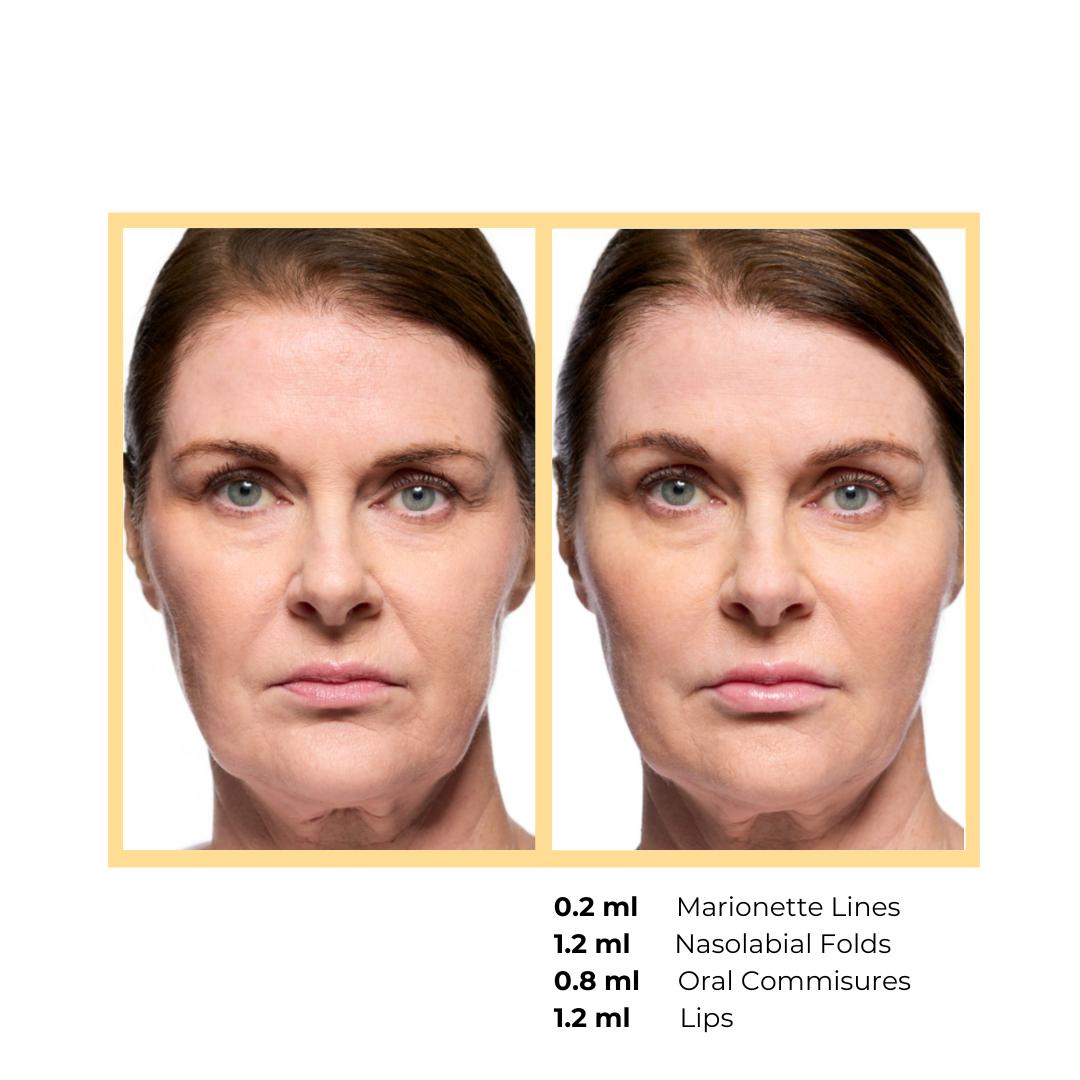 Revanesse® Versa™+ and Lips™+   in Aurora, IL and Downtown Batavia, IL