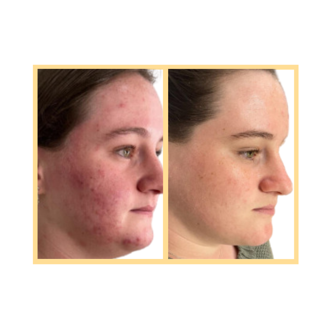 OxyGeneo™ 3-in-1 Super Facial in Aurora, IL and Downtown Batavia, IL