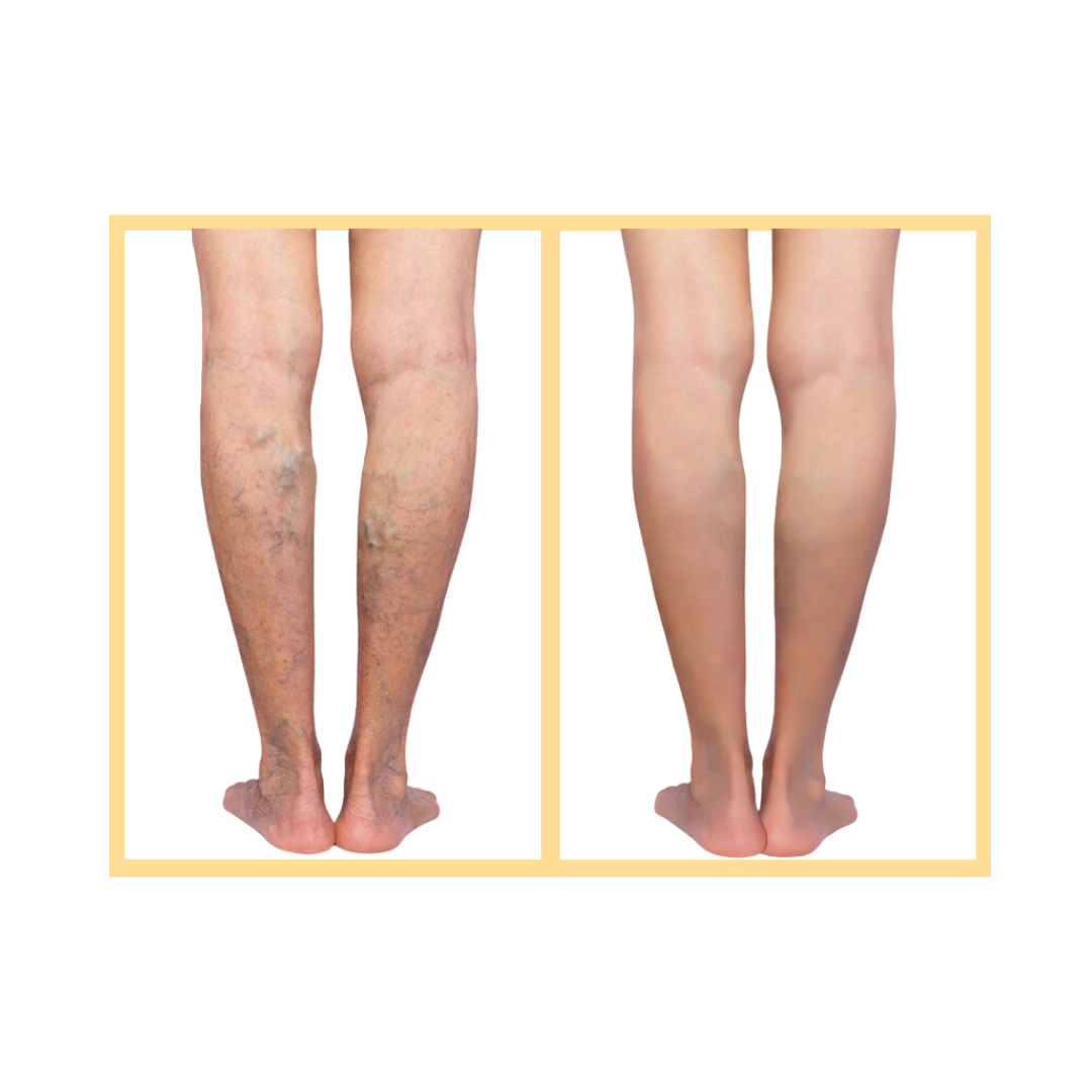 Spider Vein and Varicose Vein Treatment in Aurora, IL and Downtown Batavia, IL