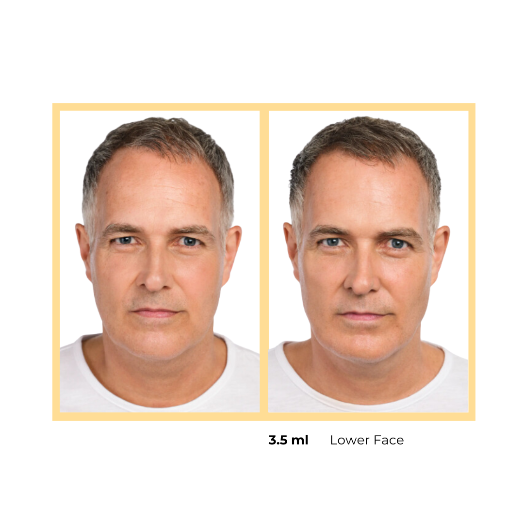 Radiesse®  Jaw Injection in Aurora, IL and Downtown Batavia, IL