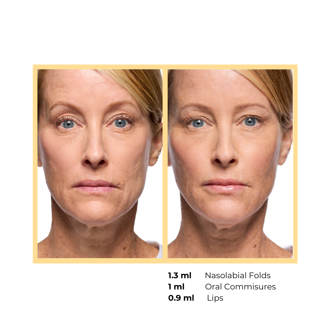 Revanesse® Versa™+ and Lips™+   in Aurora, IL and Downtown Batavia, IL
