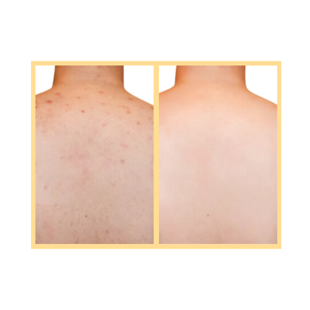 OxyGeneo Back Facial in Aurora, IL and Downtown Batavia, IL