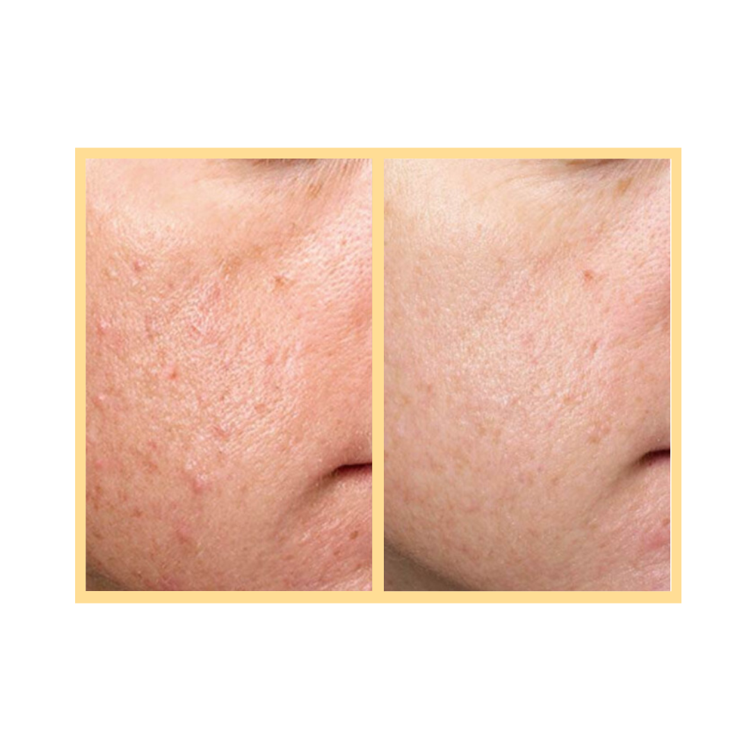 Exceed Microneedling Skin Texture Treatment in Auora, IL and Downtown Batavia, IL