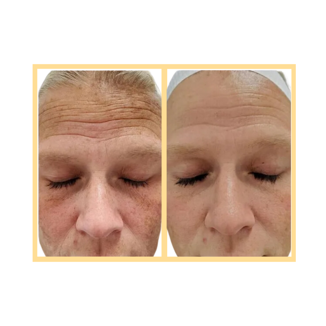 Exceed Microneedling Static Wrinkle Treatment in Auora, IL and Downtown Batavia, IL