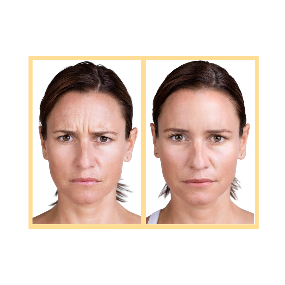 Brow Lift Botox Xeomin Wrinkle Relaxer Med Spa Treatment