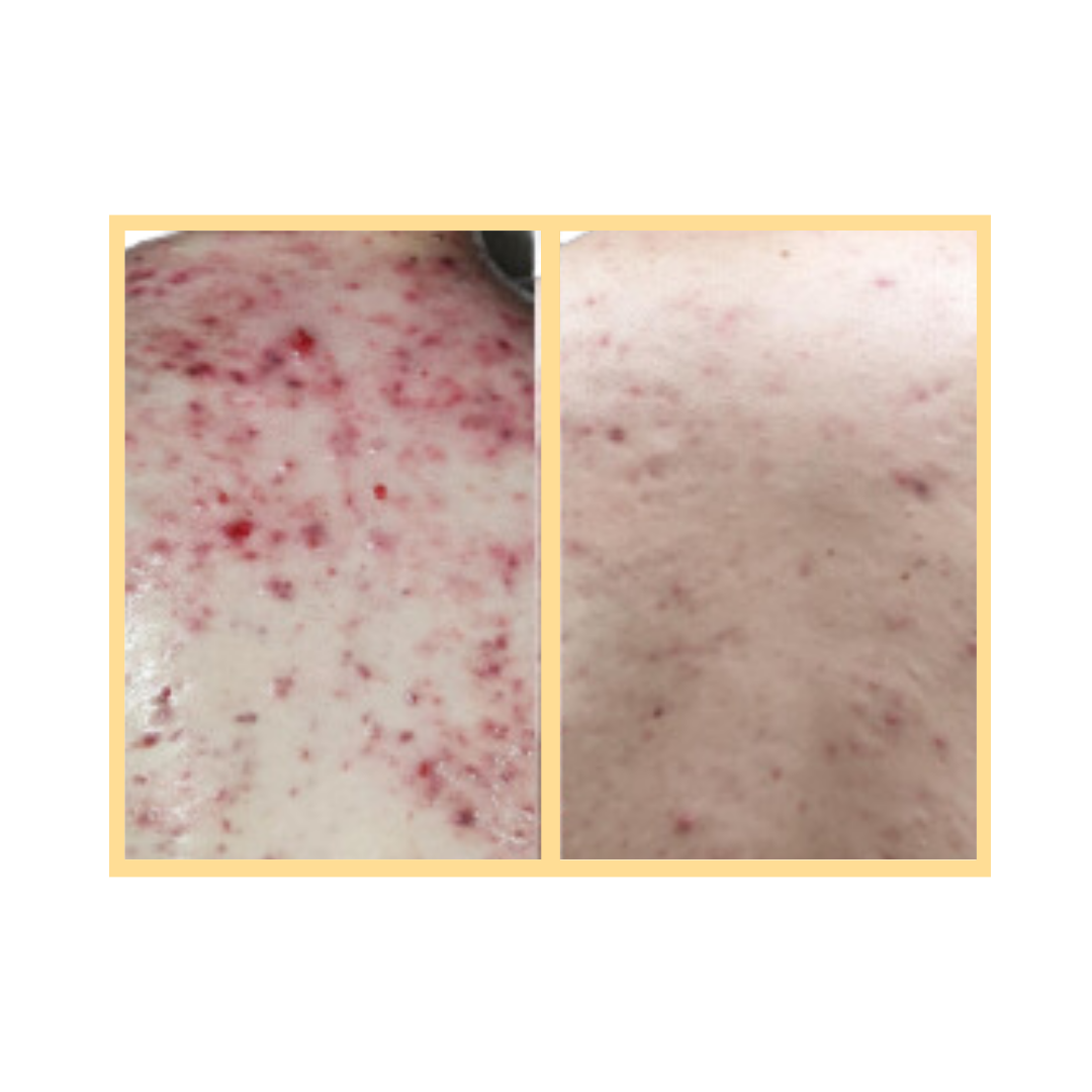 OxyGeneo Back Facial in Aurora, IL and Downtown Batavia, IL