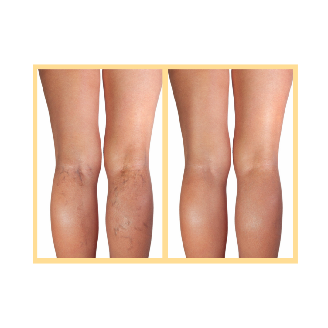 Spider Vein and Varicose Vein Treatment in Aurora, IL and Downtown Batavia, IL