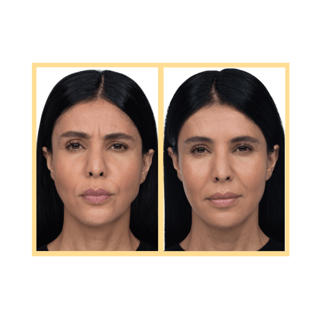Jeuveau® Injections in Aurora, IL and Downtown Batavia, IL