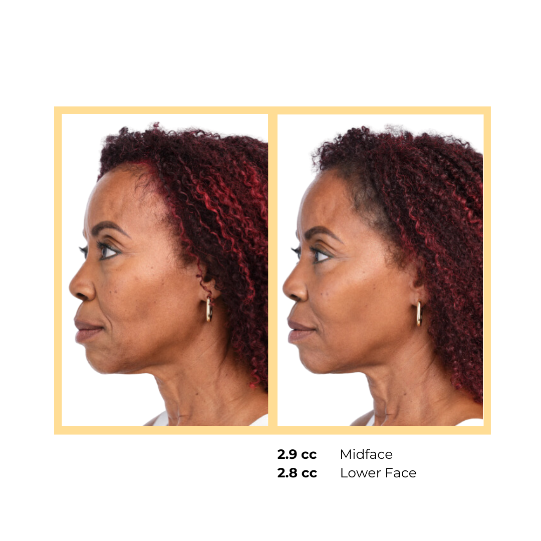 Radiesse®  Nasolabial Injection in Aurora, IL and Downtown Batavia, IL