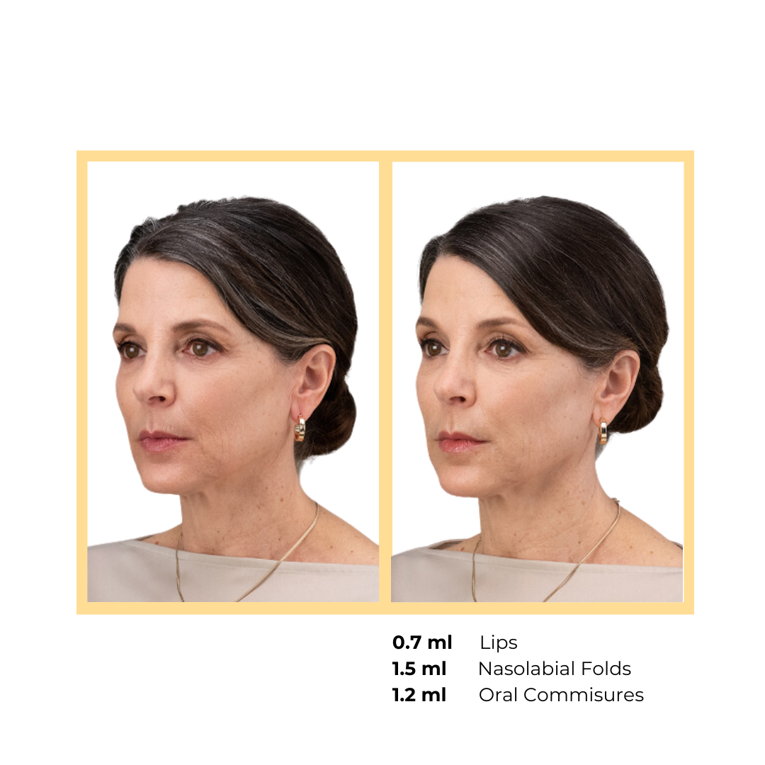 Revance RHA®  Midface and Lower Face Injection in Aurora, IL and Downtown Batavia, IL