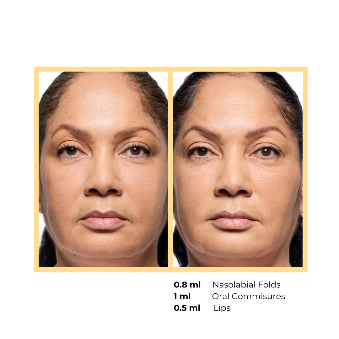Revanesse® Versa™+ and Lips™+   in Aurora, IL and Downtown Batavia, IL
