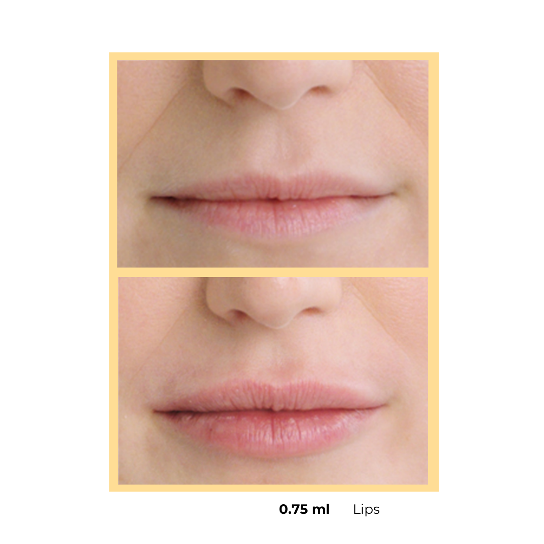Restylane®  Lip Injections in Aurora, IL and Downtown Batavia, IL