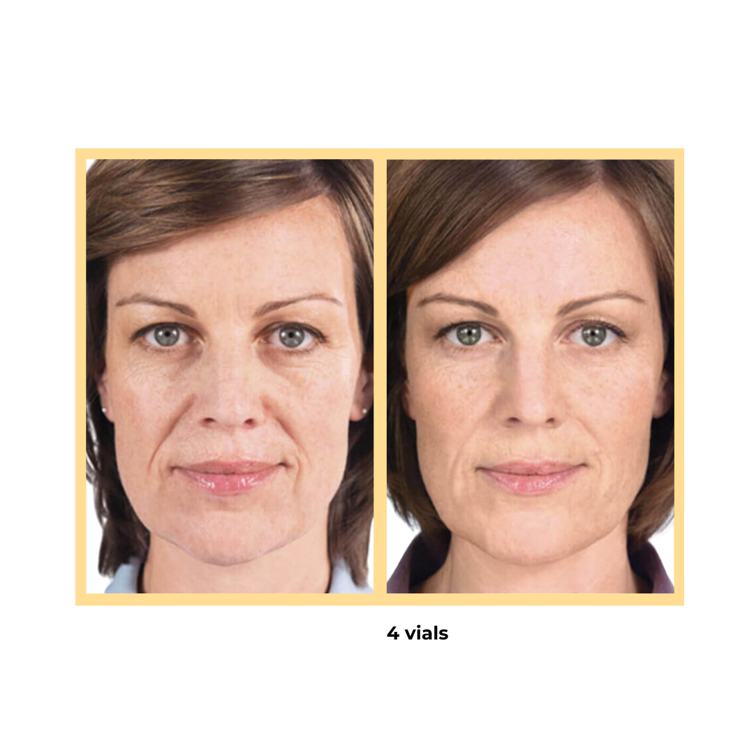 Sculptra Injections in Aurora, IL and Downtown Batavia, IL