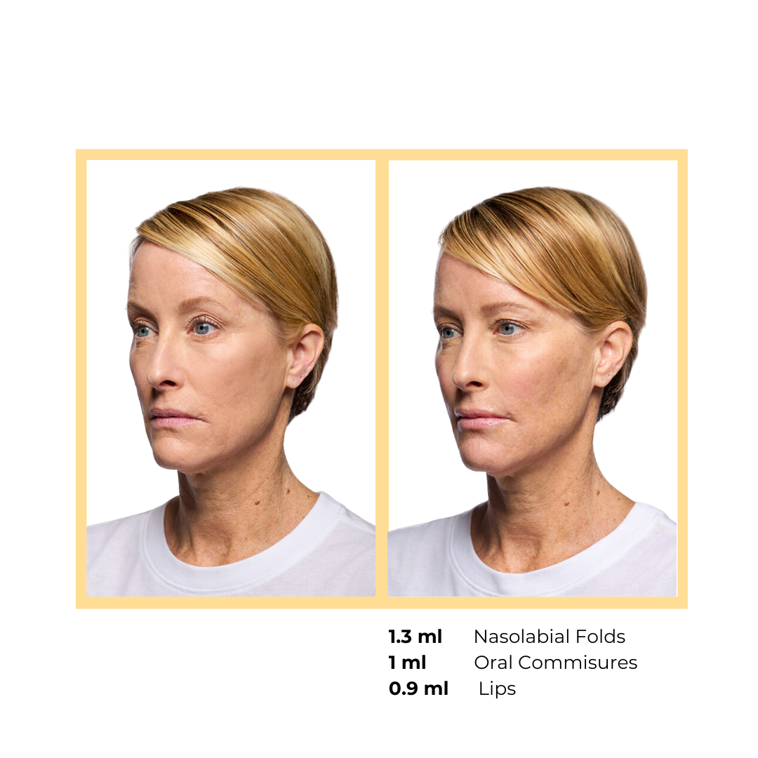 Revanesse® Versa™+ and Lips™+   in Aurora, IL and Downtown Batavia, IL