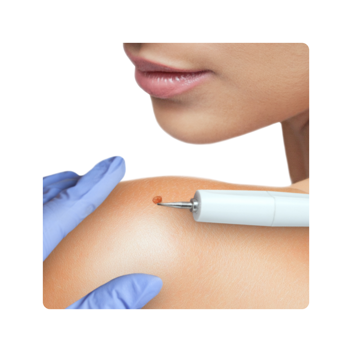 Skin Tag Removal in Aurora, IL and Downtown Batavia, IL