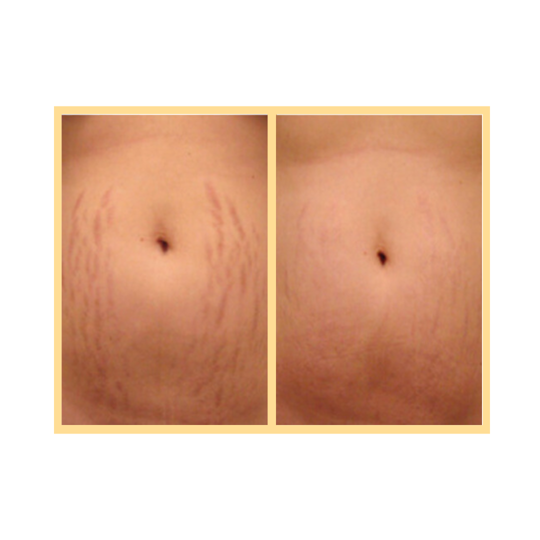Exceed Microneedling Stretch Mark Treatment in Auora, IL and Downtown Batavia, IL