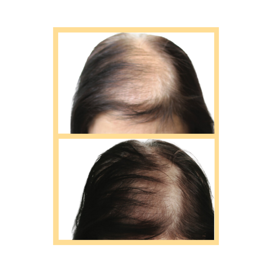 AnteAGEMD Hair Microneedling in Aurora, IL and Downtown  Batavia, IL