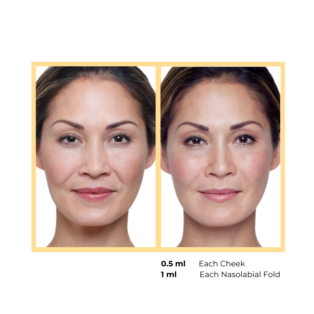 Restylane®  Nasolabial Injections in Aurora, IL and Downtown Batavia, IL