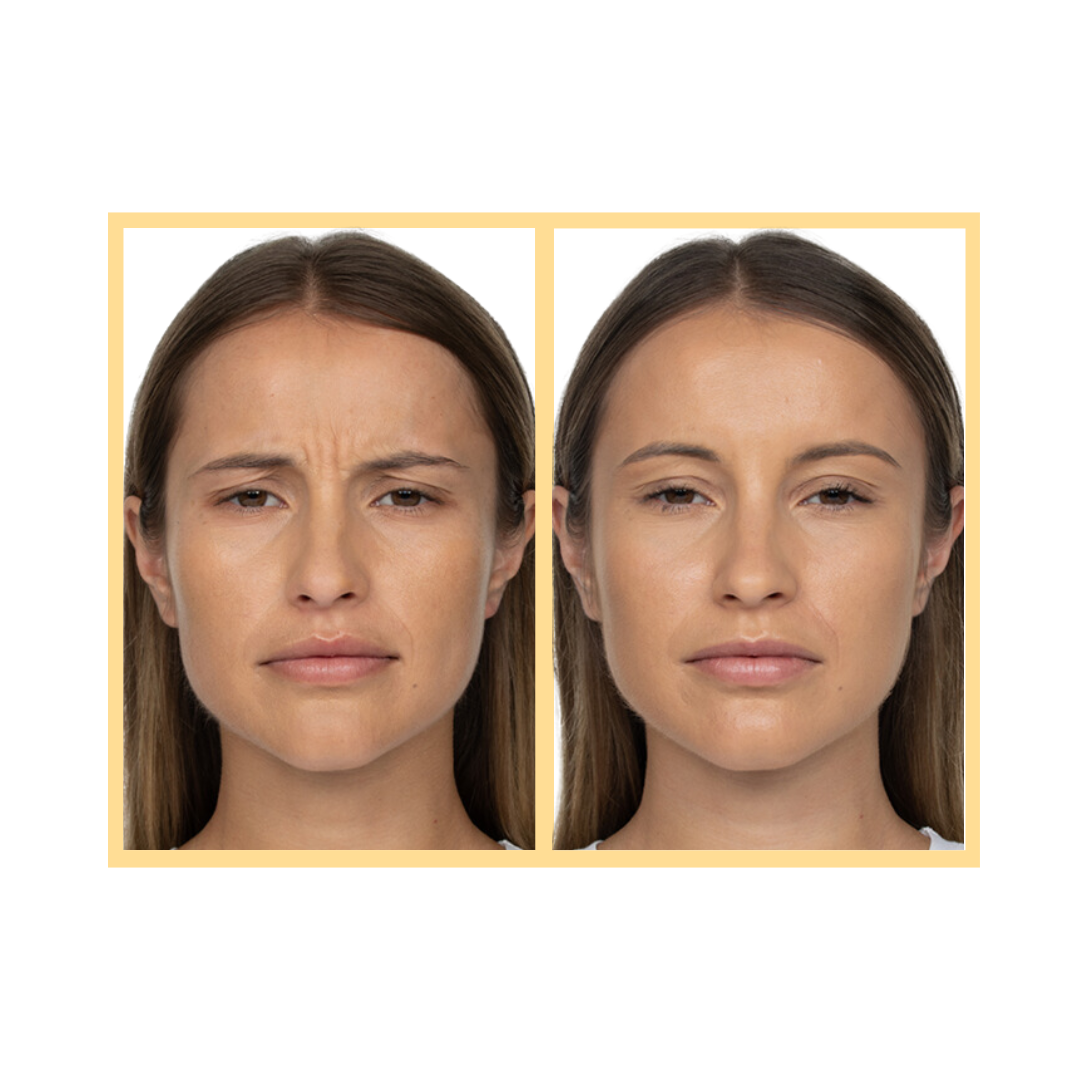 Jeuveau® Injections in Aurora, IL and Downtown Batavia, IL