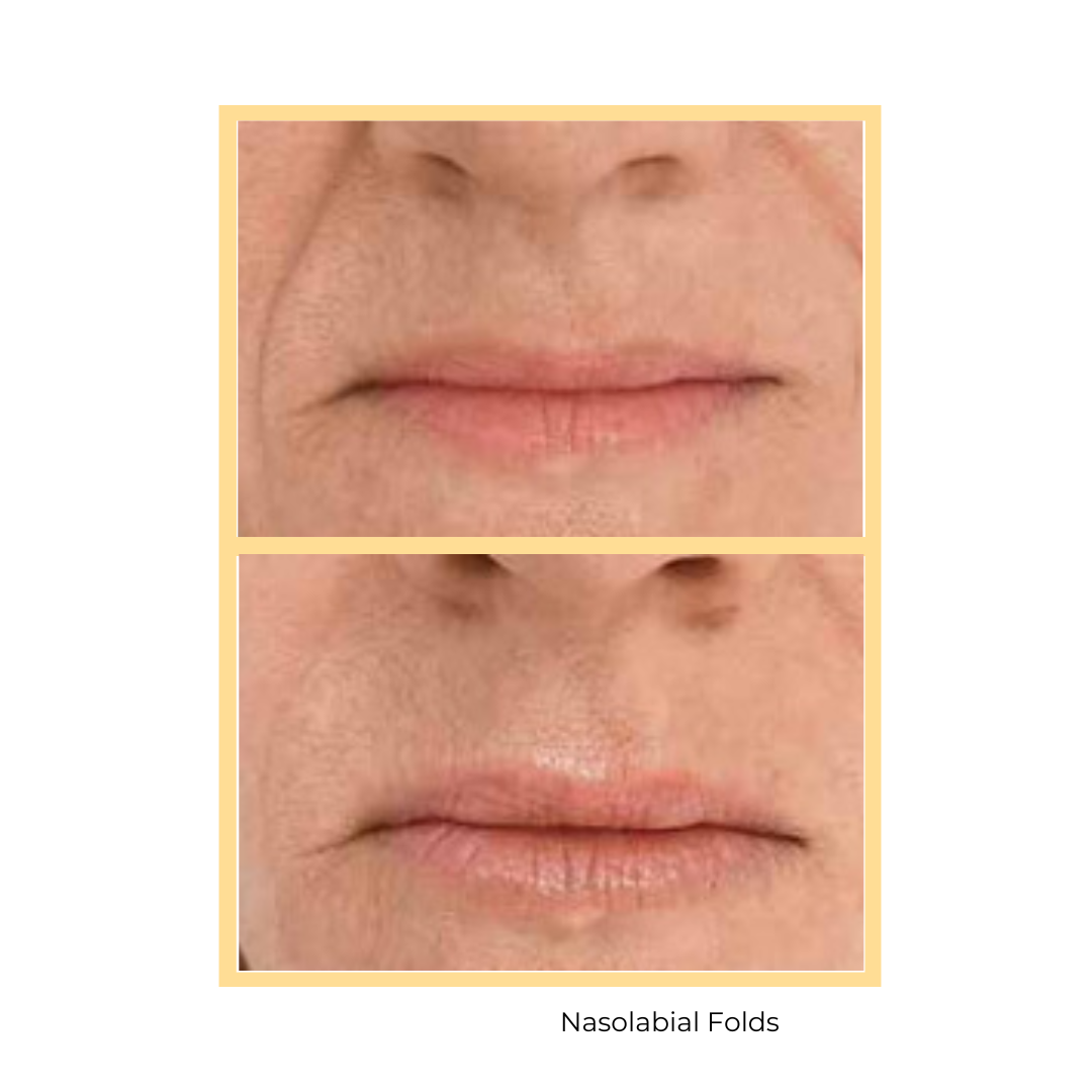 Belotero® Nasolabial Injections in Aurora, IL and Downtown Batavia, IL