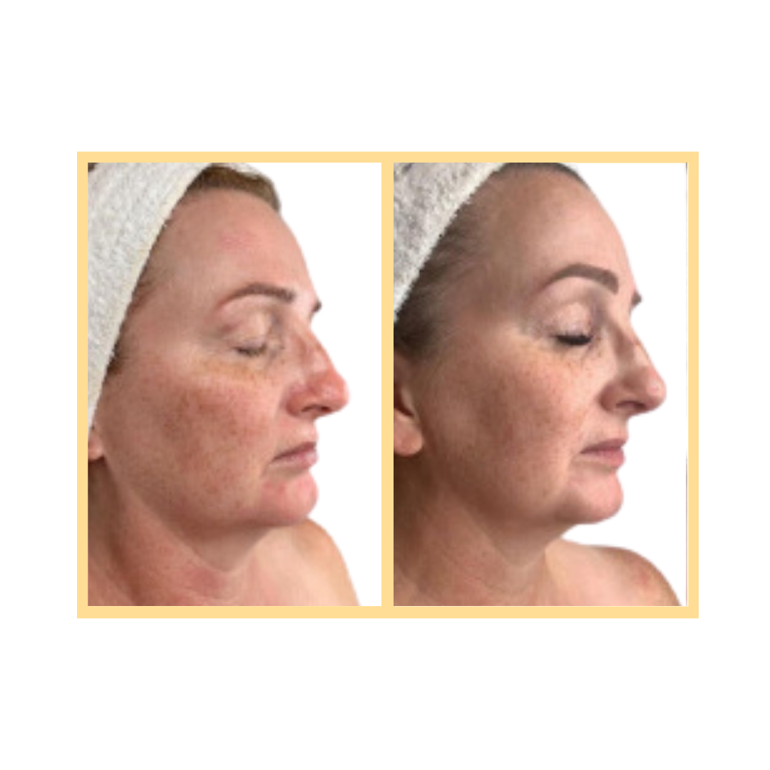 OxyGeneo™ 3-in-1 Super Facial in Aurora, IL and Downtown Batavia, IL