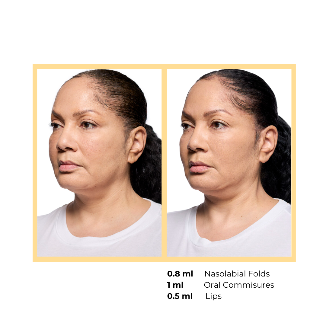 Revanesse® Versa™+ and Lips™+   in Aurora, IL and Downtown Batavia, IL