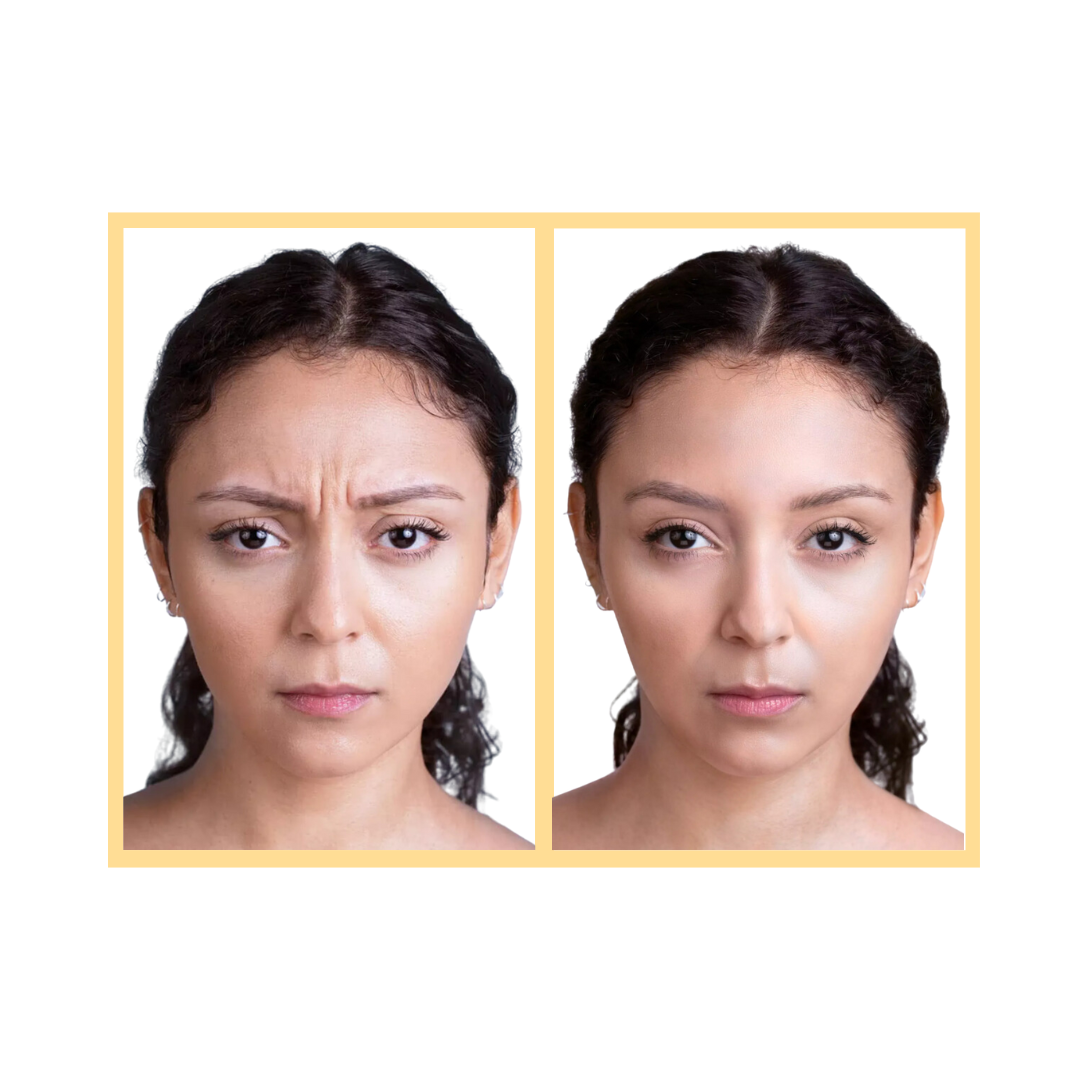 Crow's Feet Botox Dysport Wrinkle Relaxer Med Spa Treatment