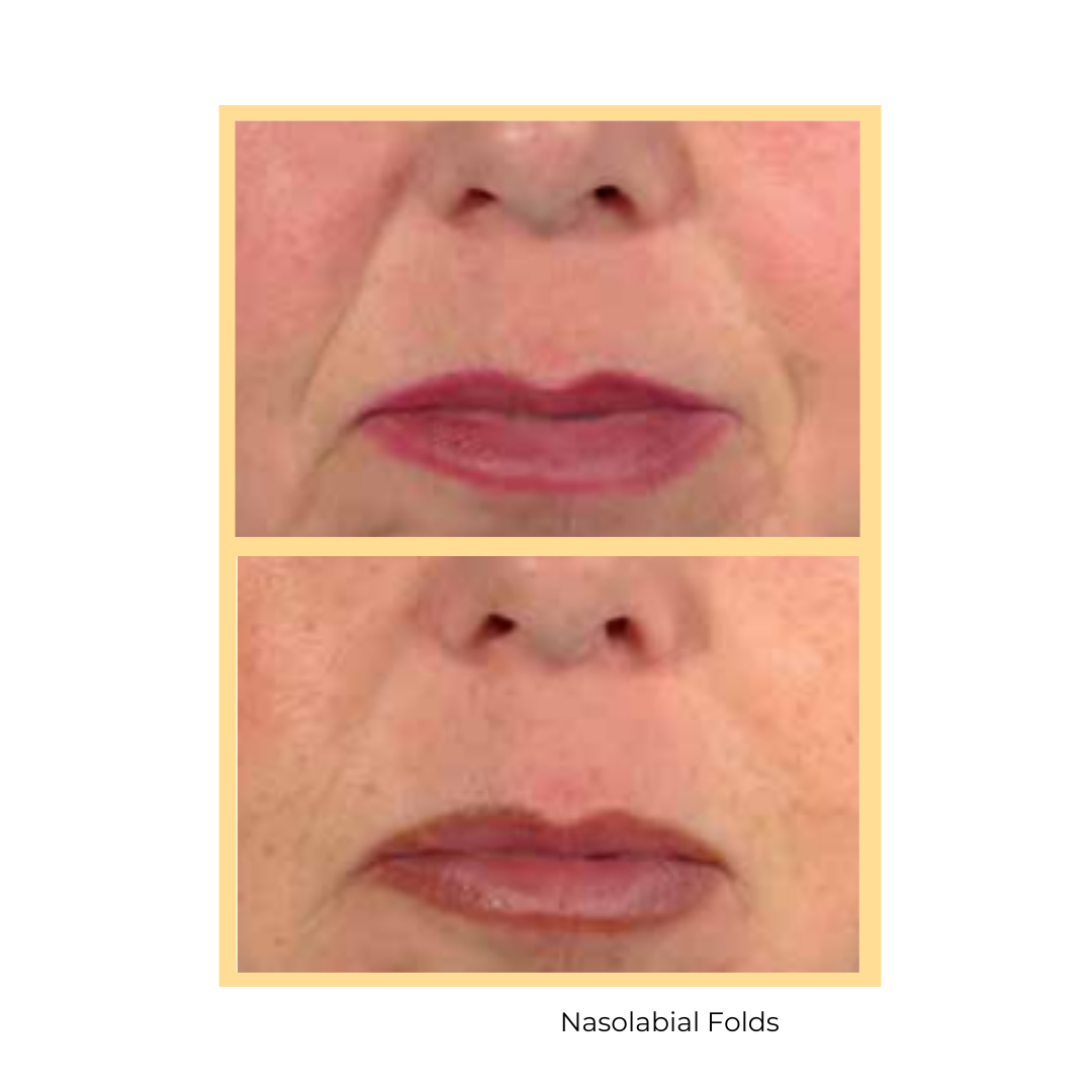 Belotero® Nasolabial Injections in Aurora, IL and Downtown Batavia, IL