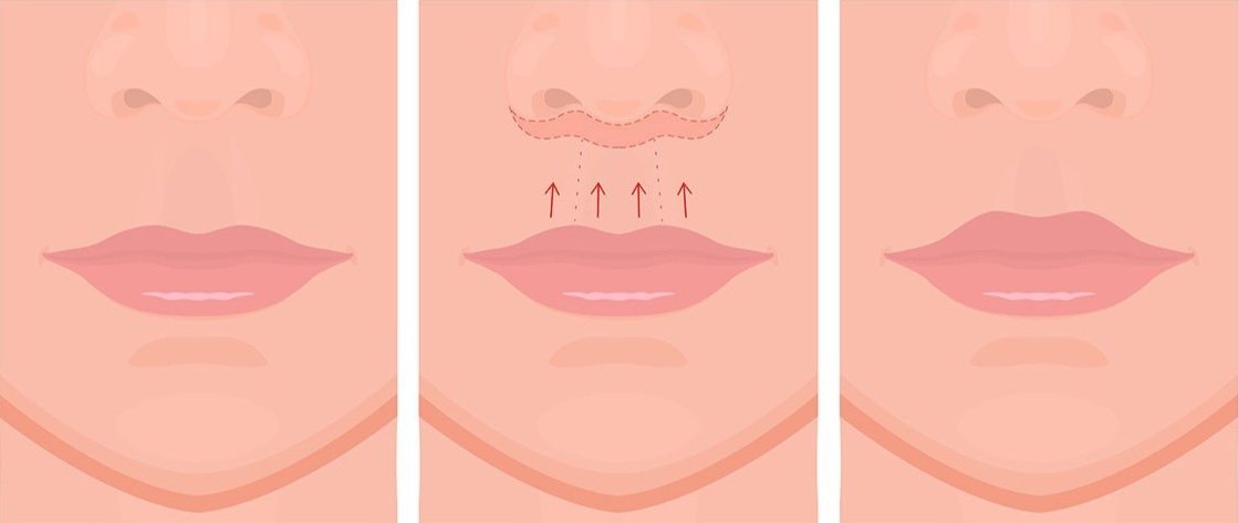 Liplift door Dr Karl Waked voor lipverjonging en esthetiek waardoor een vollere bovenlip en meer evenwichtige boven- en onderlip ontstaat
