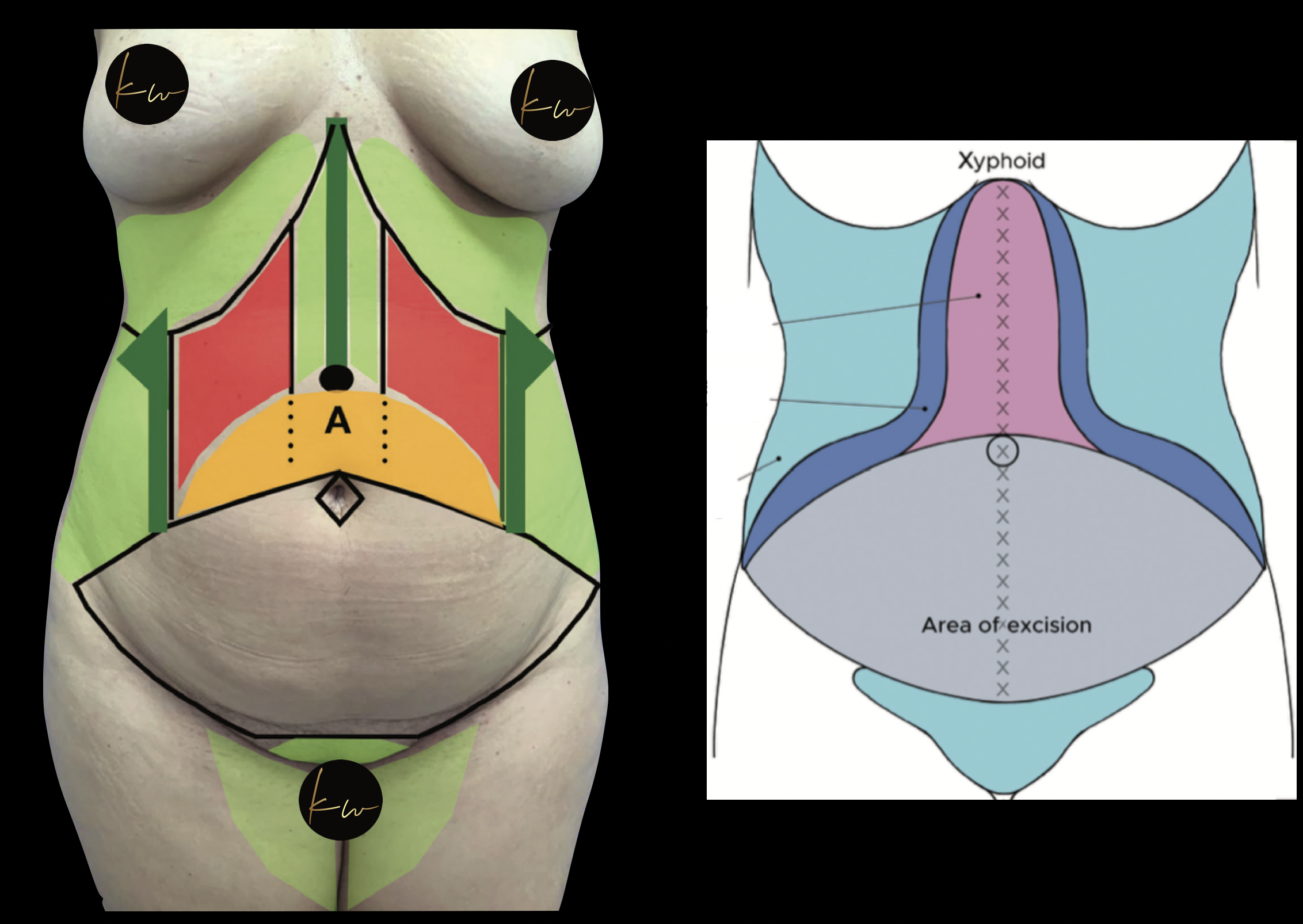 Abdominoplastie of buikwandcorrectie door een combinatie van liposuctie en excisie