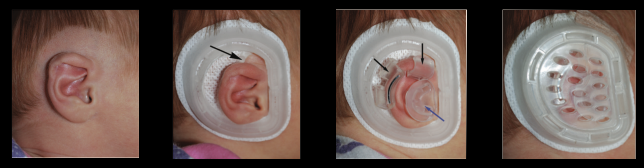 Dispositif Earwell pour la correction non chirurgicale des malformations de l'oreille chez les bébés