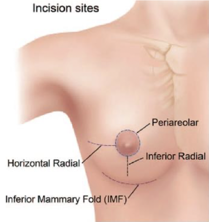 Dezelfde incisie van de mastectomie kan gewoonlijk worden gebruikt om het implantaat bij de borstreconstructie te plaatsen.